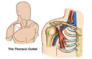 défilé throcaco brachial