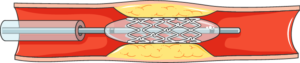 stent dans artère